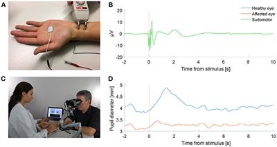 Buzzing Sympathetic Nerves: A New Test to Enhance Anisocoria in Horner's Syndrome